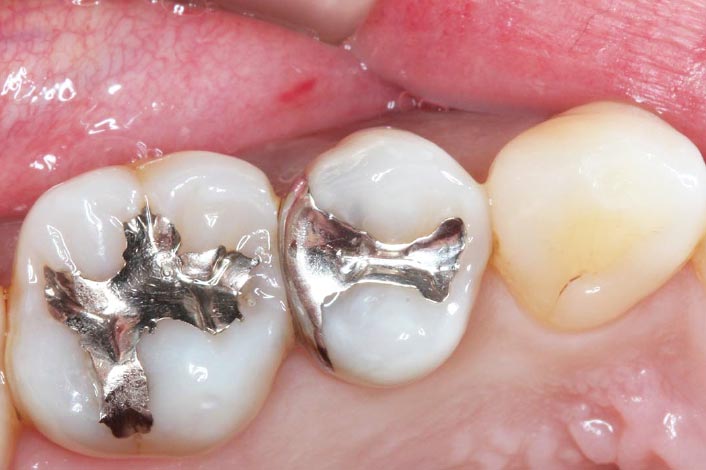 銀歯の下がむし歯になっています。