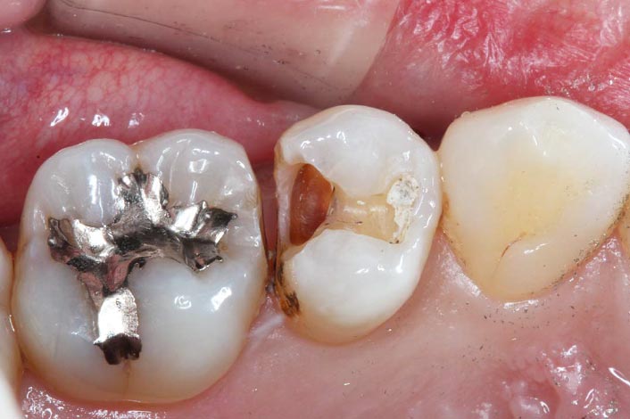 銀歯と歯の境目からむし歯になっていました。