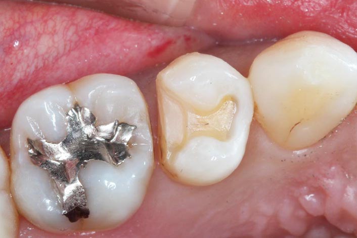 むし歯を除去し、形を整えて型採りをします。