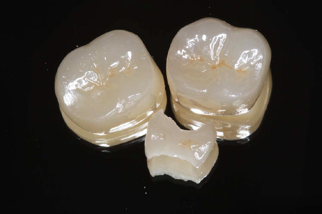 セラミッククラウン