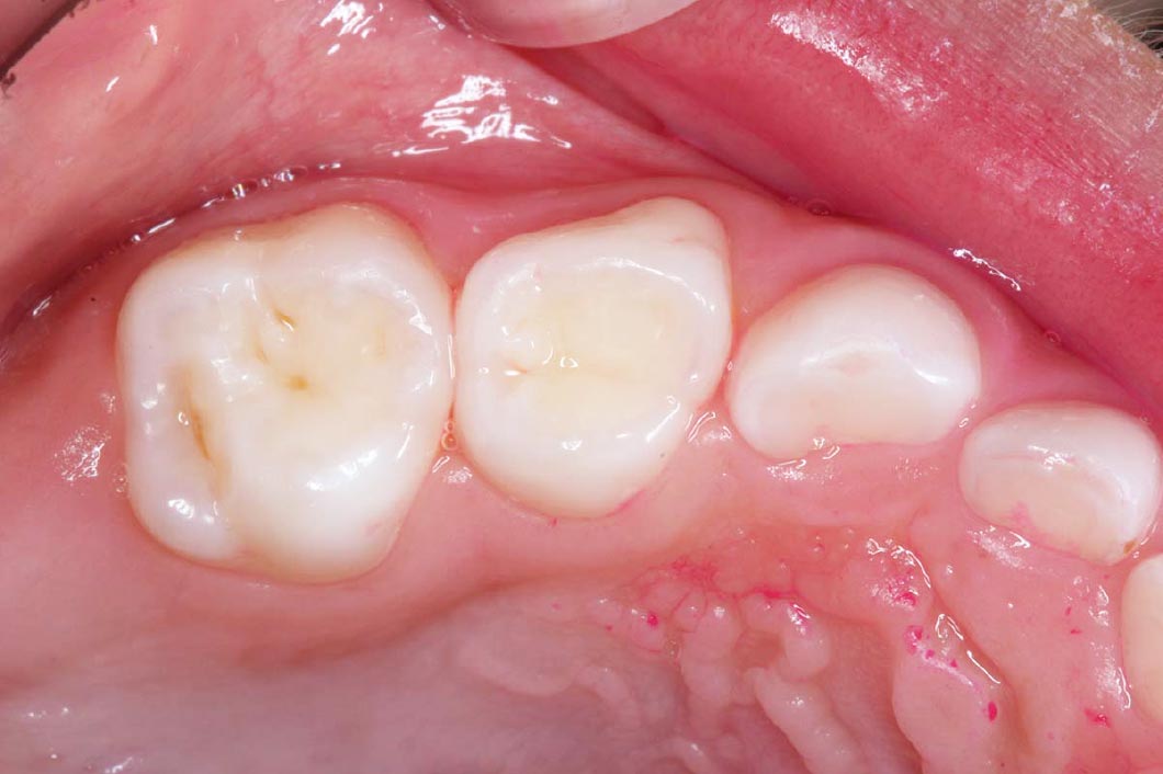 シーラント Before