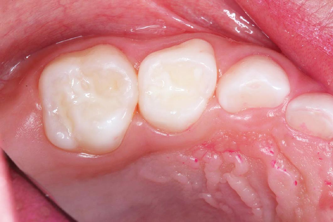 シーラント After