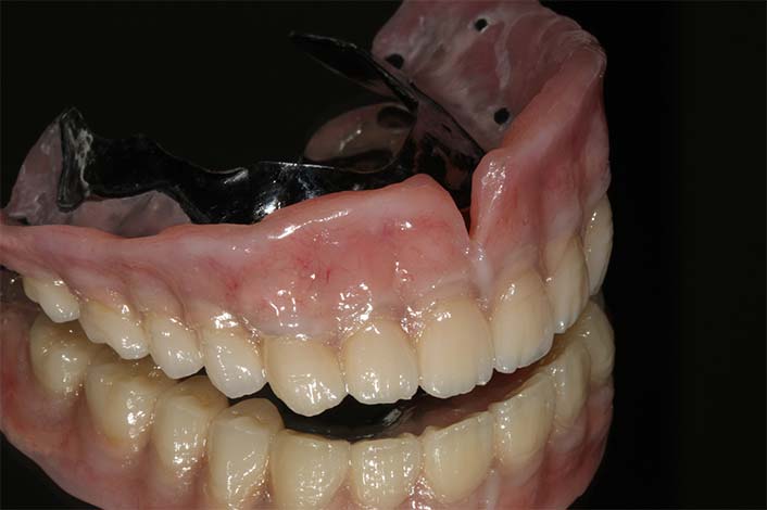 インプラント入れ歯