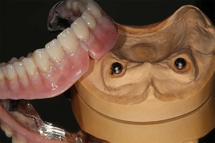 インプラント入れ歯