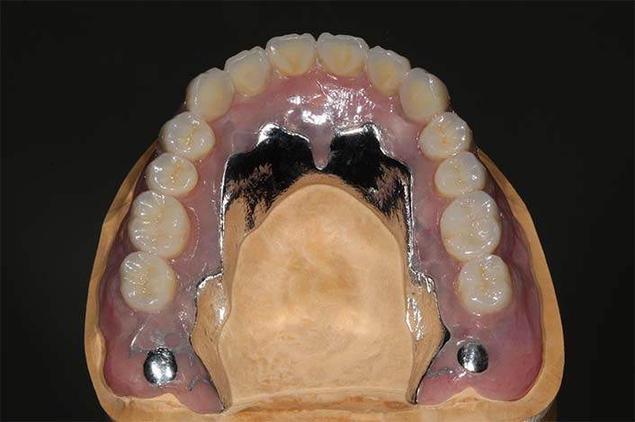 維持力があれば、入れ歯を小さくできます。
