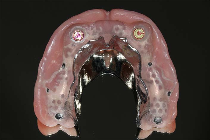 入れ歯の内面（2カ所で固定。理想は4カ所。）