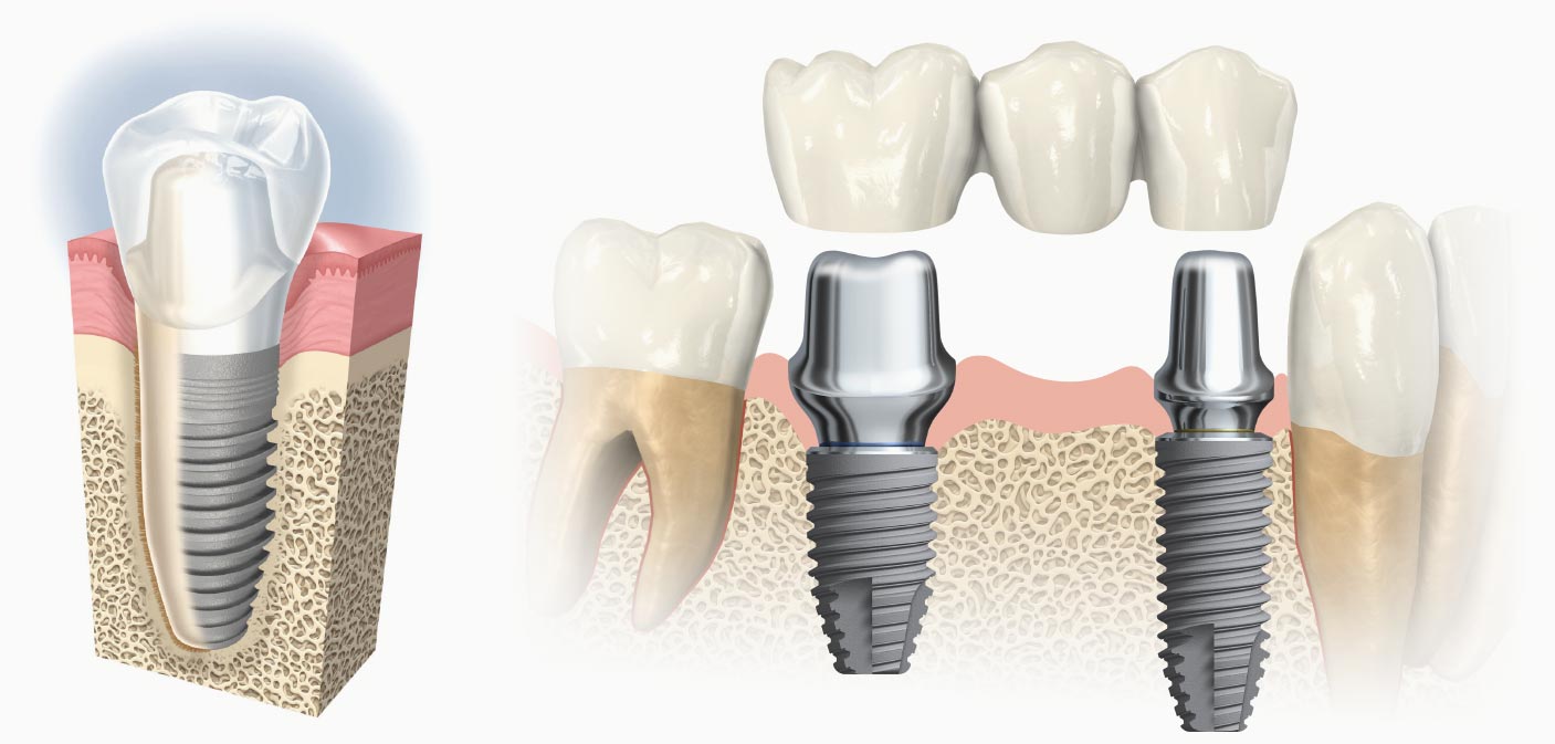 インプラントイメージ