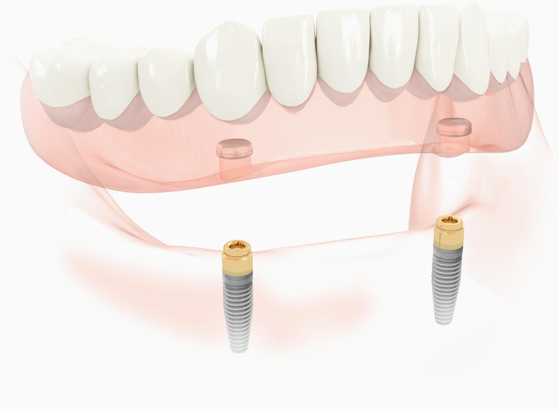 インプラント入れ歯イメージ