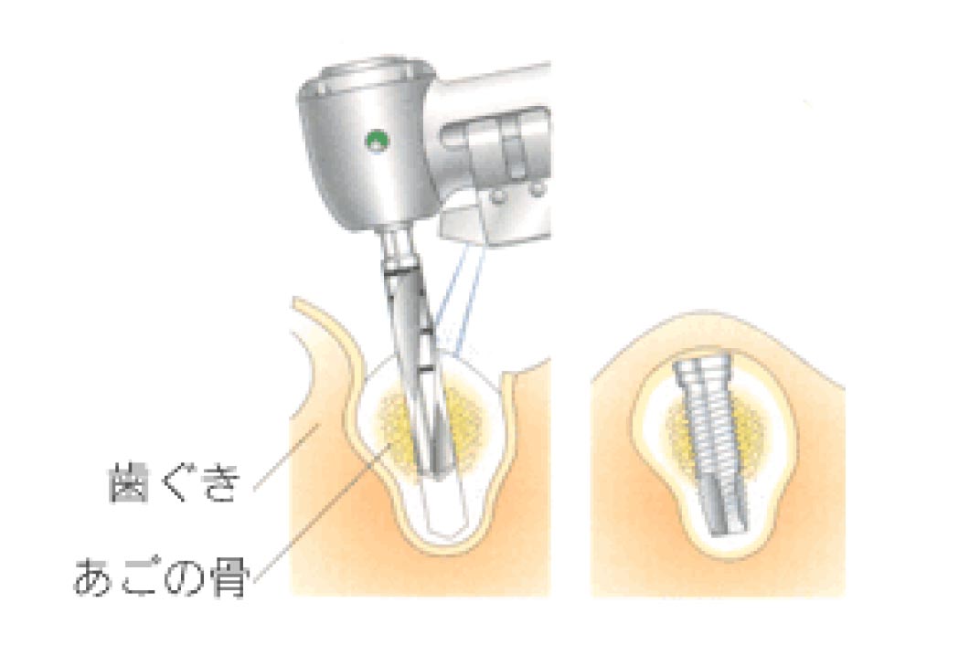 インプラントの埋入