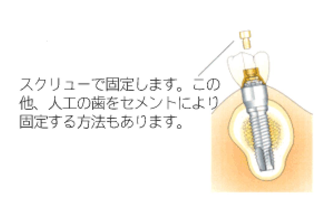 型取り・被せ物装着
