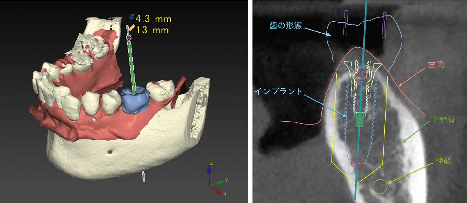コンピューター上で埋め込む角度や位置をシュミレーション