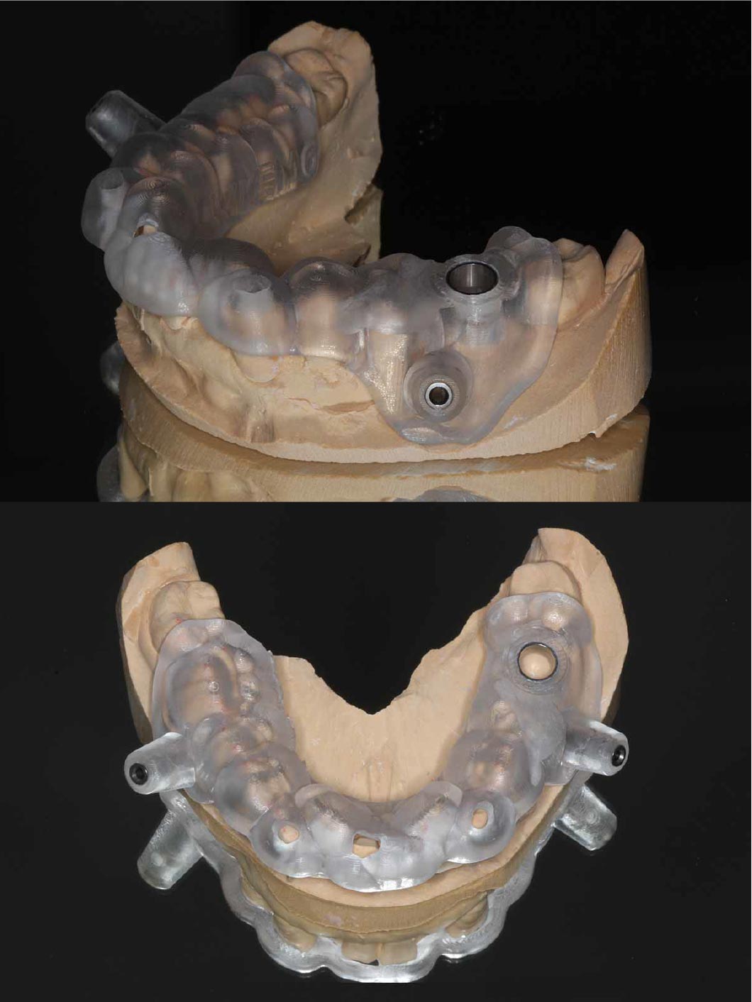 シュミレーションを元に手術用テンプレートを作成