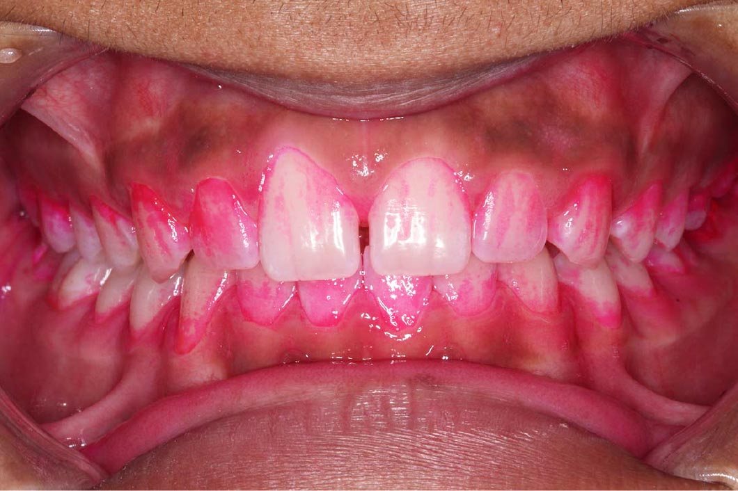 歯垢を染め磨けていない部位をチェック