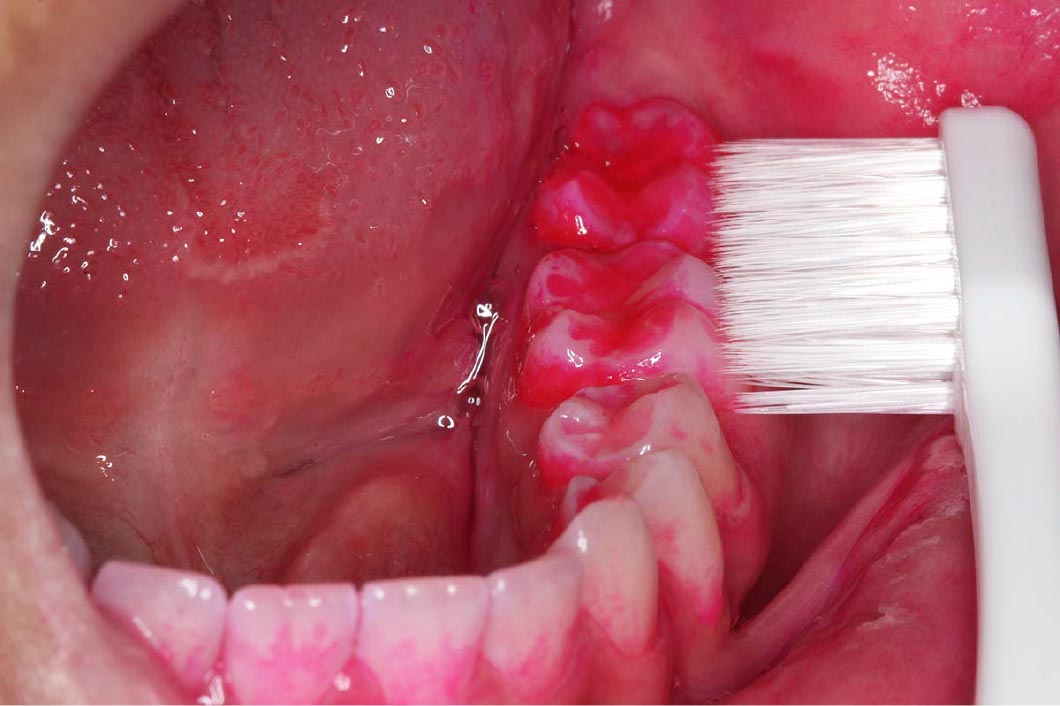 正しいブラッシング方法を指導