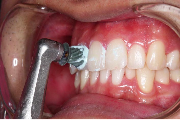 ペーストで磨いている写真